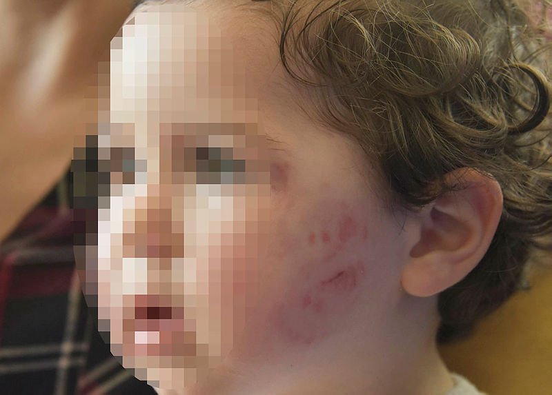 Kreşte skandal: 1,5 yaşındaki kız çocuğuna dayak iddiası!