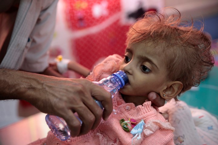 Yemen’de yaklaşık 85 bin çocuk yetersiz beslenmeden ölmüş olabilir