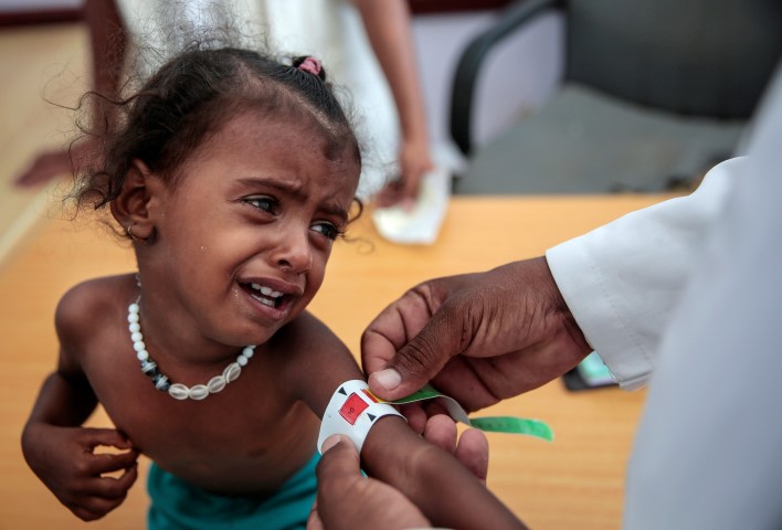 Yemen’de yaklaşık 85 bin çocuk yetersiz beslenmeden ölmüş olabilir
