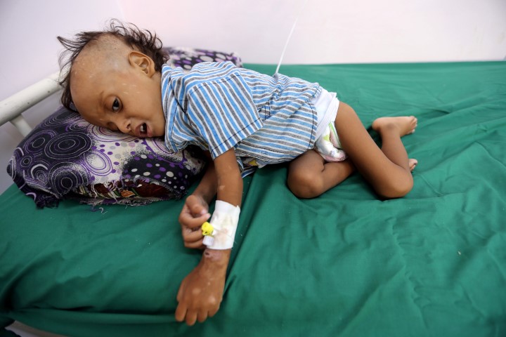 Yemen’de yaklaşık 85 bin çocuk yetersiz beslenmeden ölmüş olabilir