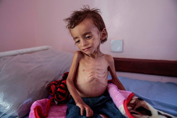 Yemen’de yaklaşık 85 bin çocuk yetersiz beslenmeden ölmüş olabilir