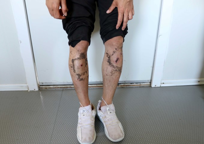 Yunanistan’da göçmen zulmü devam ediyor! Bu kez de plastik mermi ve şok cihazı...