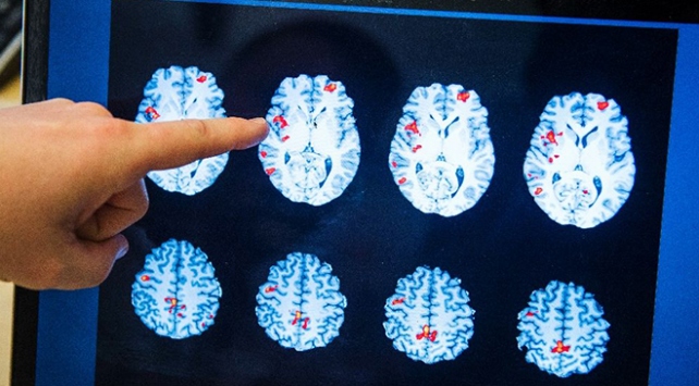 Son dakika haber: Hastaneye gitti, hayatının şokunu yaşadı! 60 yıl beyninin yarısı olmadan yaşadı