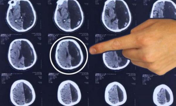 Son dakika haber: Hastaneye gitti, hayatının şokunu yaşadı! 60 yıl beyninin yarısı olmadan yaşadı