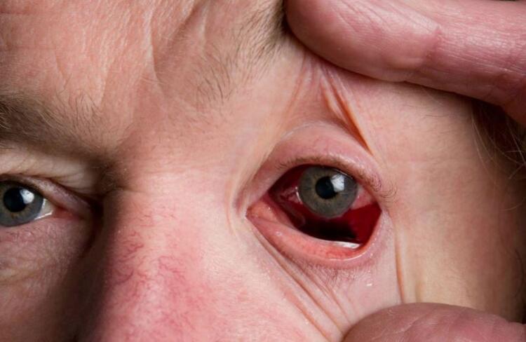 Dünya bu son dakika haberini konuşuyor: Hastalığa yakalananlar gözleri kanayarak ölüyor! DSÖ kırmızı alarm verdi, çalışmalar başladı