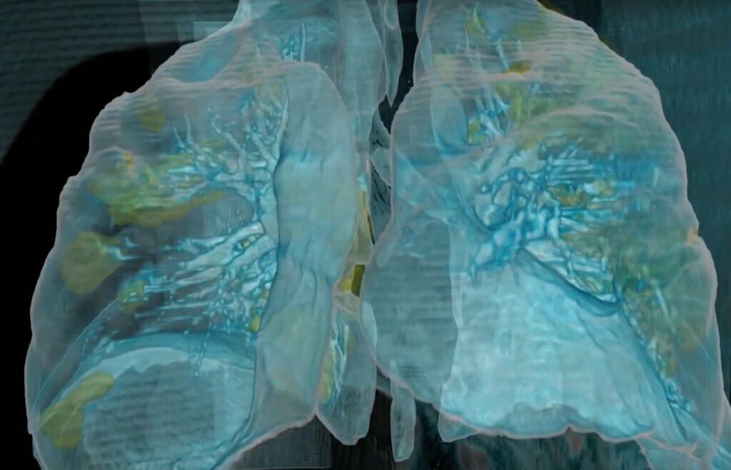 SON DAKİKA HABER: Corona virüsü hastalarının otopsisinde şok ayrıntı! Ölenlerde virüsün devamlılığı görüldü