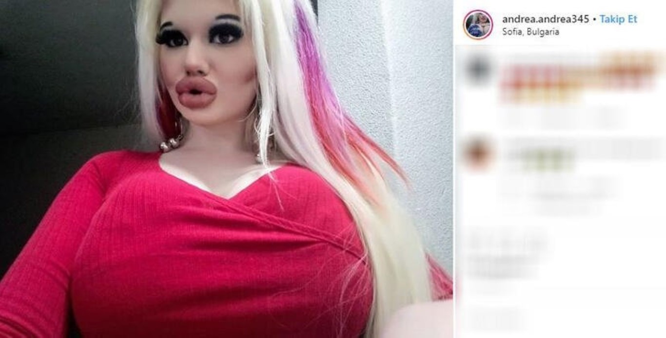 Büyük dudaklara sahip olmak için servet harcamıştı! Daha fazla dolgu yaptırmak istiyorum