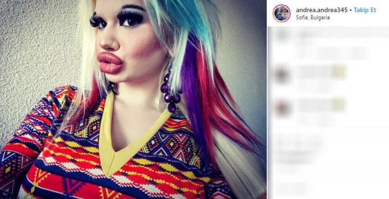 Büyük dudaklara sahip olmak için servet harcamıştı! Daha fazla dolgu yaptırmak istiyorum