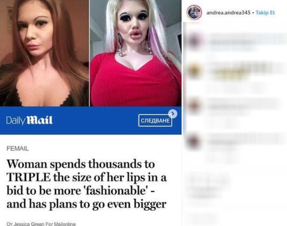 Büyük dudaklara sahip olmak için servet harcamıştı! Daha fazla dolgu yaptırmak istiyorum