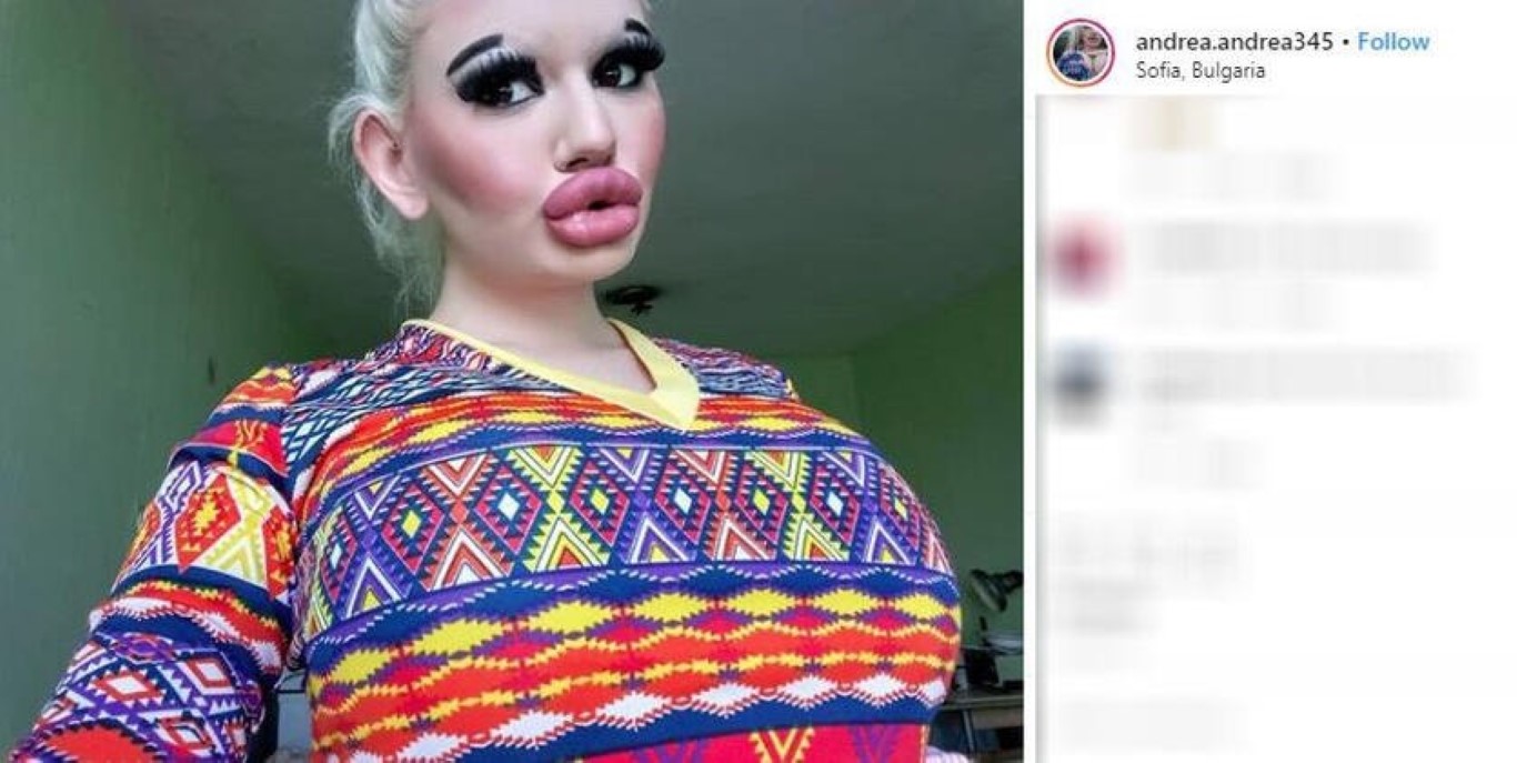 Büyük dudaklara sahip olmak için servet harcamıştı! Daha fazla dolgu yaptırmak istiyorum