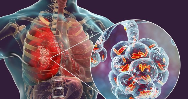 Son Dakika Corona virüs haberi! Sağlık Bakanı Fahrettin Koca en fazla pnömoni zatürre görülen illeri açıkladı!