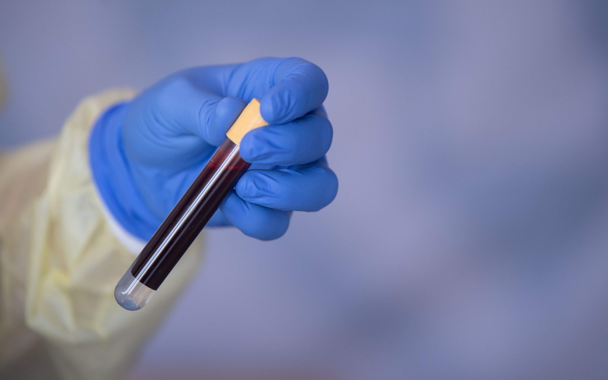 SON DAKİKA: Corona virüste yeni bulgu: 4 ay sonra bile ortaya çıkıyor