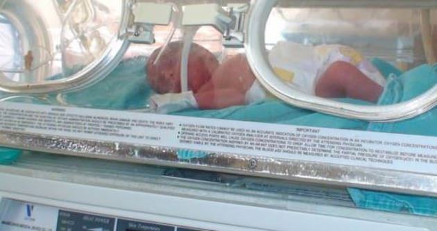 Siyam ikizleri ameliyatla ayrıldı