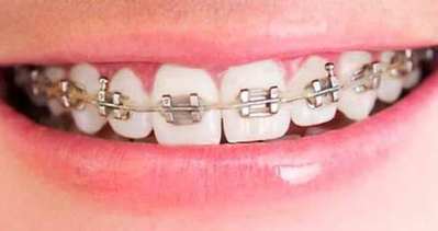 Ortodonti tedavi süresi kısalıyor