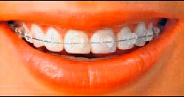 Ortodontik tedavinin yaşı yok