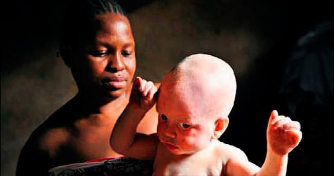 Tanzanya’da albinolu bir çocuk daha katledildi