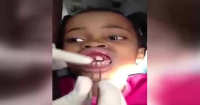 Küçük kızın diş etinden 15 tane kurtçuk çıkarıldı