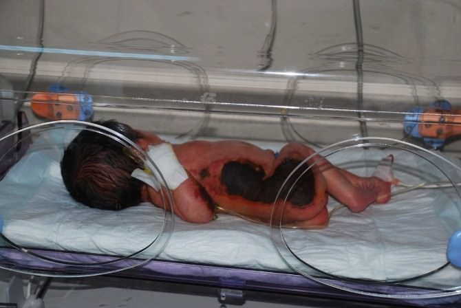 Hastanede Doğum Sonrası Isıtıcıda Unutulan Bebekte Yüzde 40 Oranında Yanık Oluştu