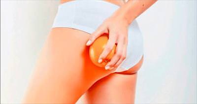 Dişilik hormonunun bir başka cilvesi: Selülit