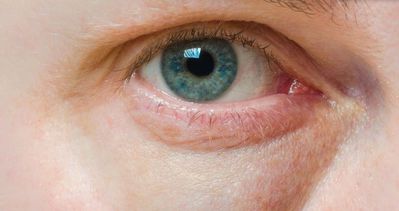 Göz altı morluklarında doğal tedavi