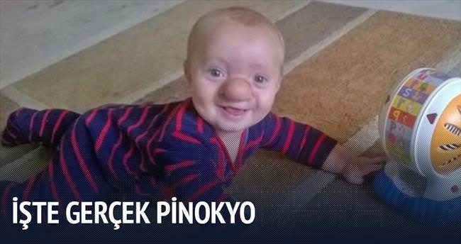 ’Gerçek Pinokyo’ 21 aylık Ollie