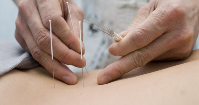 Akupunktur gebelik şansını artırıyor mu?
