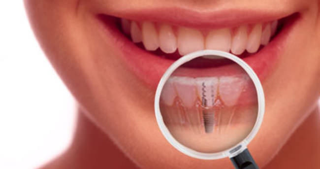 İmplant ile sağlıklı dişlere kavuşun