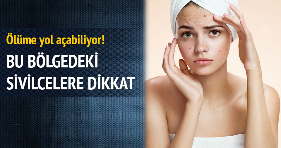 Bu Bolgede Cikan Sivilcelere Dikkat Kadin Haberleri