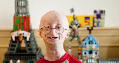 Progeria nedir? Erken yaşlanma hastalığı nedenleri?