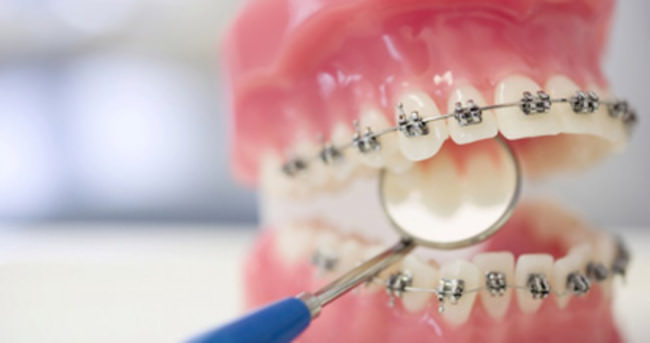 Diş telleriyle tedavi süresi hakkında tüm bildiklerinizi unutun!