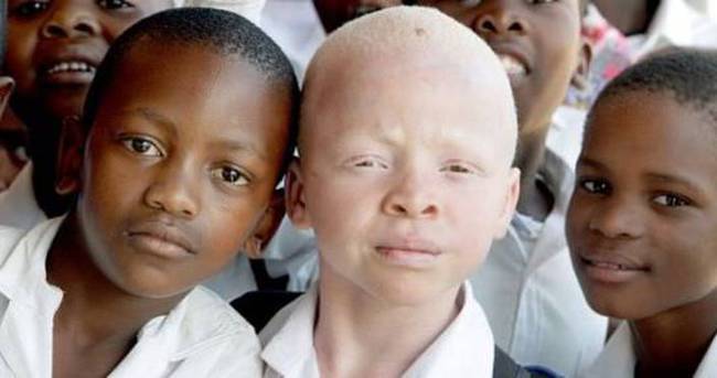 Afrika’nın talihsiz beyazları albinolar