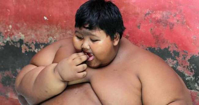 Endonezya’da 192 kilogram çocuk tedaviye alındı