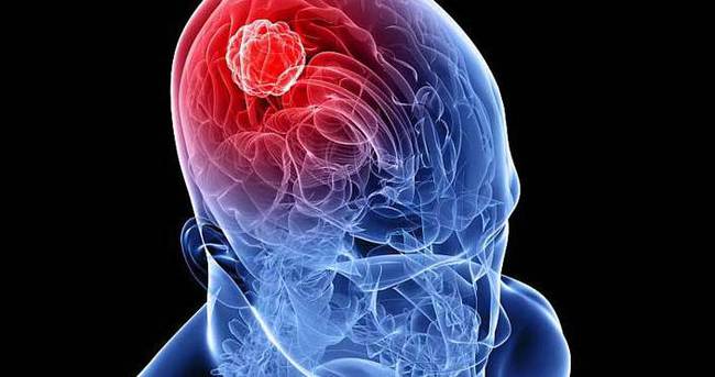 Beyin Tumoru Belirtileri Nelerdir Saglik Haberleri