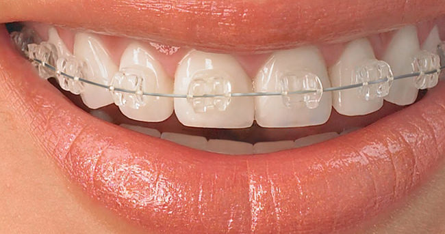 Sadece birkaç ay süren diş teli tedavisi mümkün