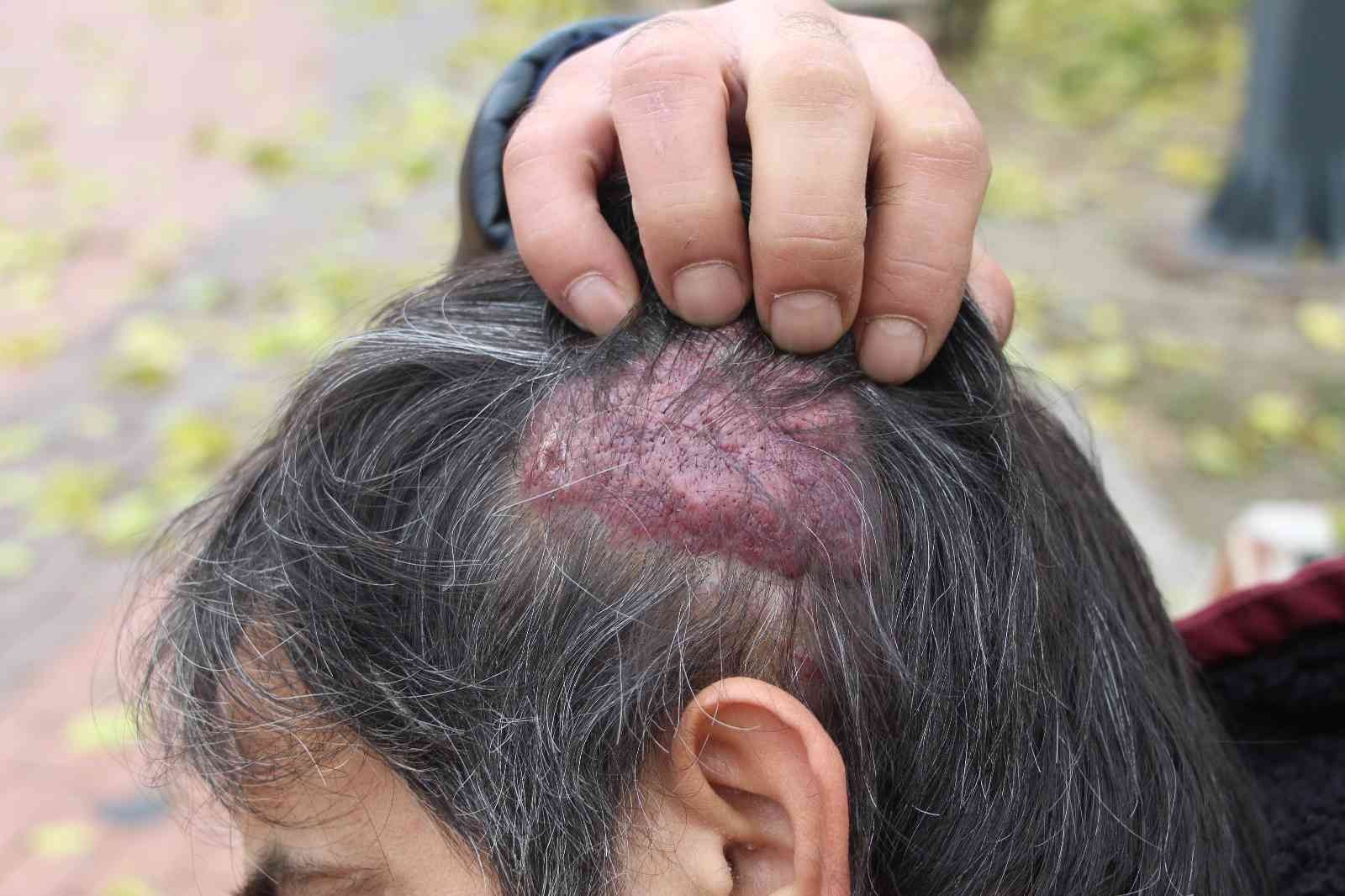 Başında oluşan kistten muzdarip olan hastaya 12 yıldır teşhis konulamadı #batman