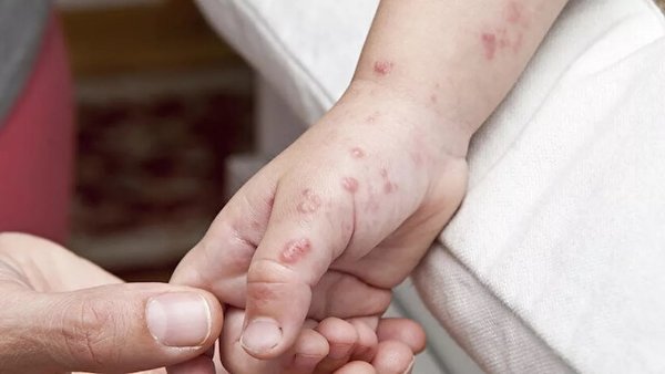 Maymun çiçeği bu kez Yeni Zelanda’da görüldü