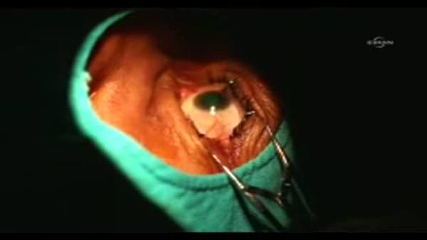 Bir hastanın gözünden 10 santimetre uzunluğunda solucan çıkarıldı
