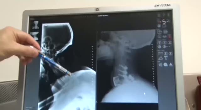 Öksürünce boynu kırıldı