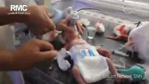 Suriyeli bebek başında şarapnel parçasıyla doğdu (+18)