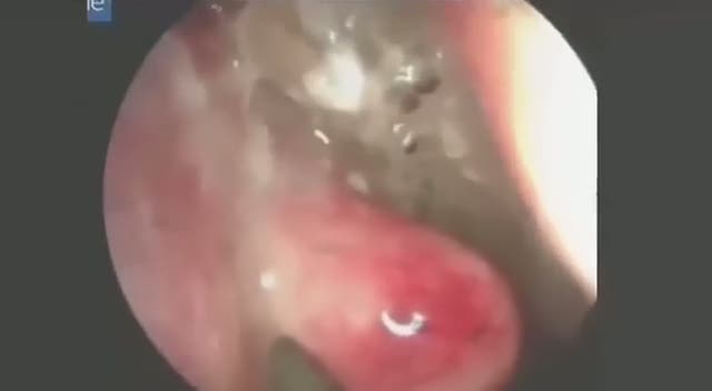 Burnundan 55 tane kurtçuk çıktı
