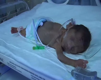 700 gramlık bebek hayata tutunmaya çalışıyor