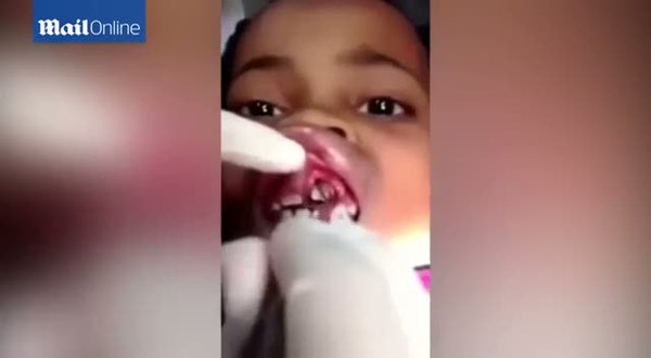 15 yaşındaki kızın dişinden kurt çıktı