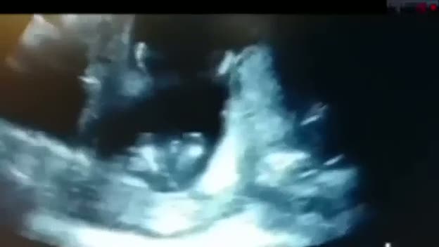 Anne karnında alkış tuttu, ultrasona böyle yansıdı