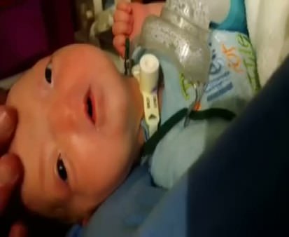 Burunsuz doğan bebek 197 milyonda bir ilk