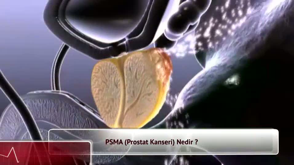 P.S.M.A. (Prostat) kanseri nedir?