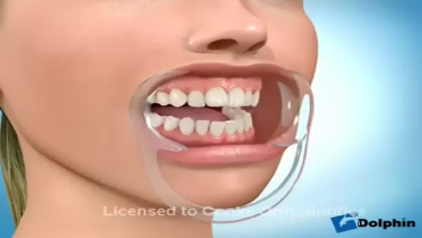 Diş teli nasıl takılır?