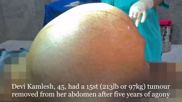 Hintli kadının bedeninden 97 kiloluk tümör çıkarıldı