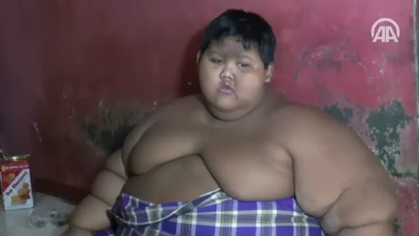Endonezya'da 192 kilogram ağırlığındaki çocuk tedaviye alındı